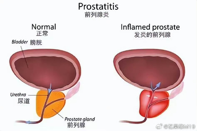 前列腺炎的最佳治療方法探討，前列腺炎最佳治療方法探討與解析