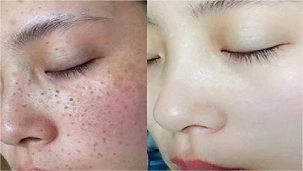 哪種祛斑方法最有效不反彈，全面解析最有效的祛斑途徑，全面解析，最有效的祛斑方法，不反彈之選！