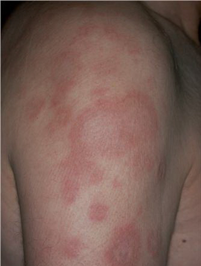 艾滋病紅斑早期圖片，了解、預(yù)防與應(yīng)對，艾滋病紅斑早期圖片詳解，預(yù)防與應(yīng)對策略