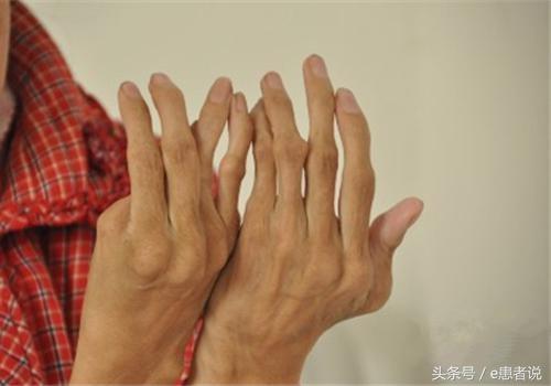 風濕性關節(jié)炎的最佳治療方案，風濕性關節(jié)炎的最佳治療策略或方案