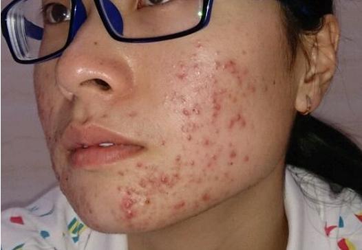 如何去除青春痘，男生的護膚指南，男生護膚指南，如何有效去除青春痘