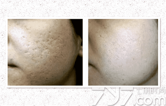 5次點(diǎn)陣激光去痘坑效果深度解析，五次點(diǎn)陣激光去痘坑深度解析，效果與影響探討