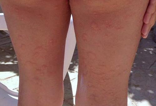 蕁麻疹的治療方法，全方位解析與應對策略，全方位解析蕁麻疹治療方法與應對策略