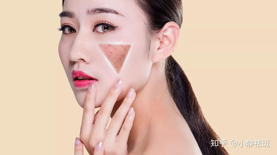 如何有效去除臉上的雀斑，最佳方法全解析，全面解析，如何有效去除臉上雀斑的方法