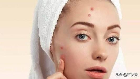 痤瘡是什么——深入了解痤瘡的成因、癥狀與治療方法，痤瘡解析，成因、癥狀及治療方法全面介紹