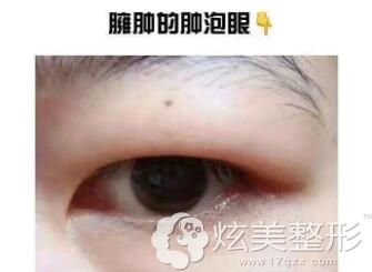 腫眼泡抽脂手術(shù)費(fèi)用詳解，多少錢？，腫眼泡抽脂手術(shù)費(fèi)用解析，手術(shù)費(fèi)用究竟是多少？